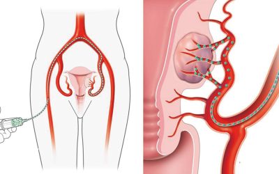 Protocole de l’embolisation des fibromes utérins